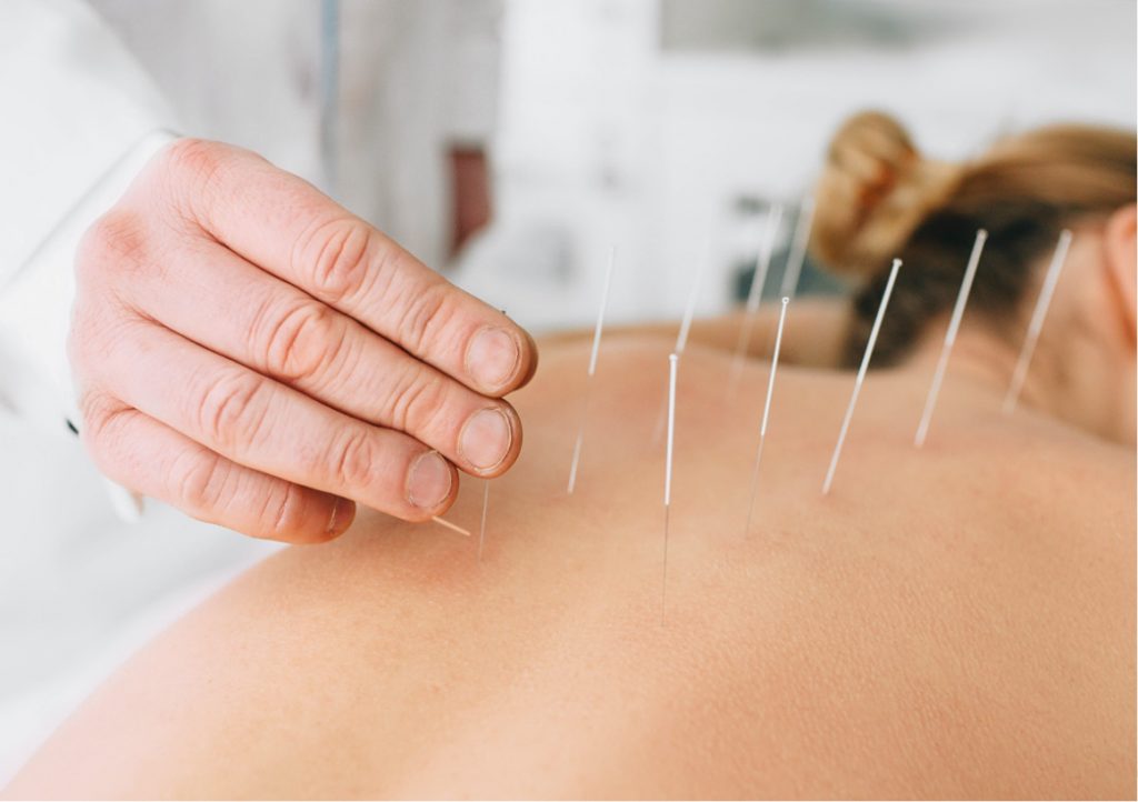 Dry Needling Back To Action Chiropractic And Rehab